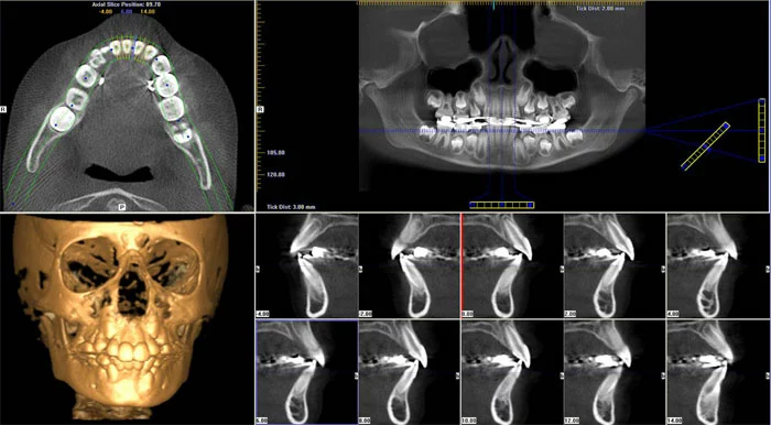 Dijital tomografi ile çekilmiş ağız içi filmi