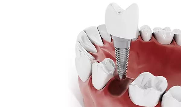 Çene kemiğine implant uygulaması