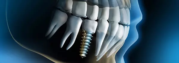 Dental Tomografi görseli
