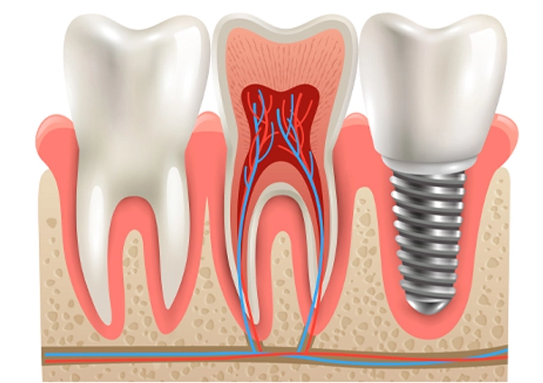 Çene kemiğindeki implant