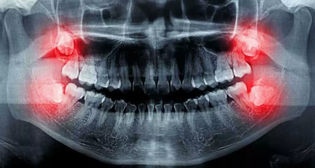Gömülü 20 yaş dişlerinin tomografide görünmesi